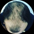 Saç Prp Tedavisi , Saç Prp Tedavisi Fiyatları